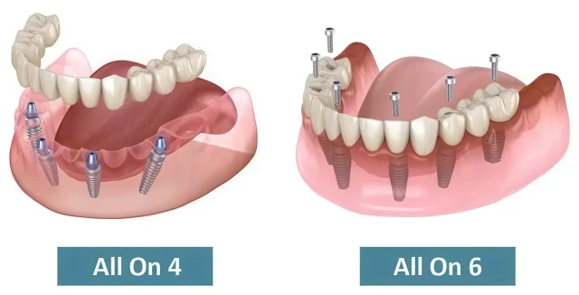 All-on-6 vs All-on-4: сравнение методик для пациентов с атрофией кости