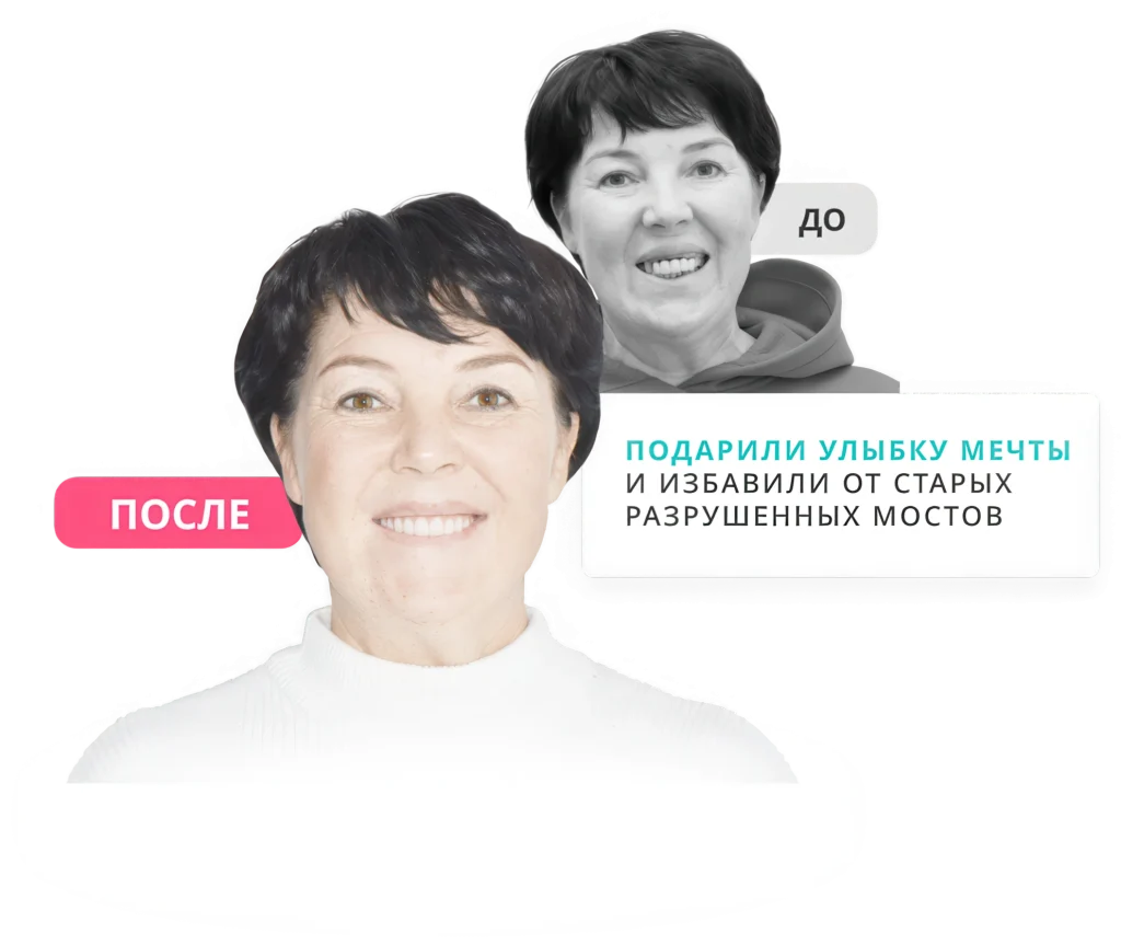 До и после имплантации зубов