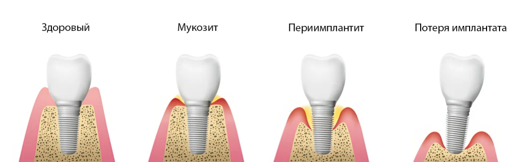 Периимплантит