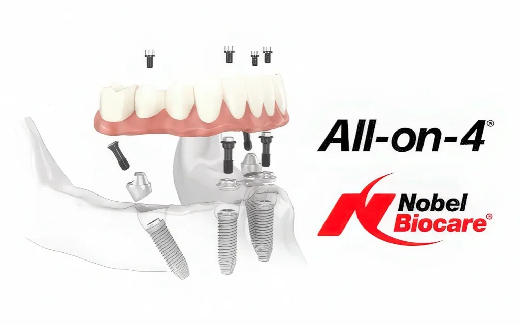 Импланты All-on-6 от Nobel Biocare