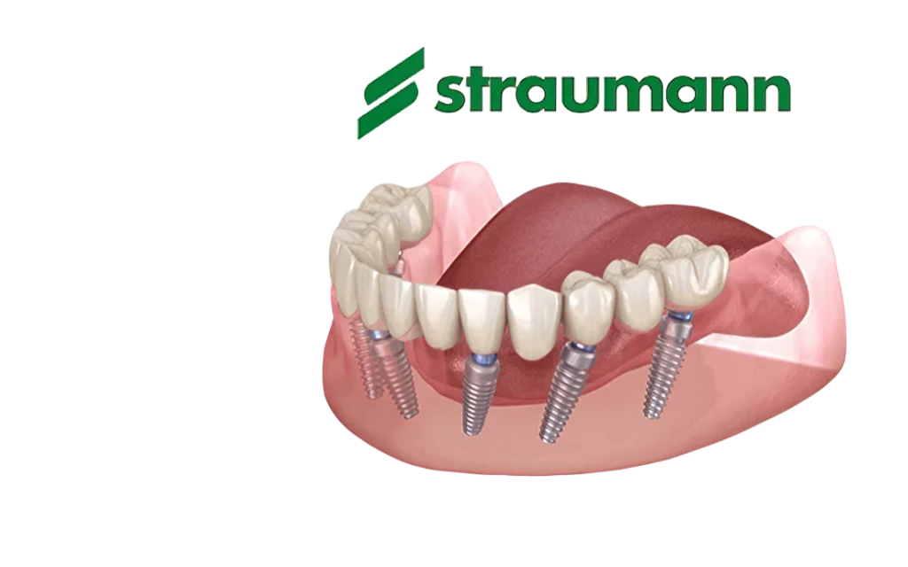 Импланты All-on-6 от Straumann
