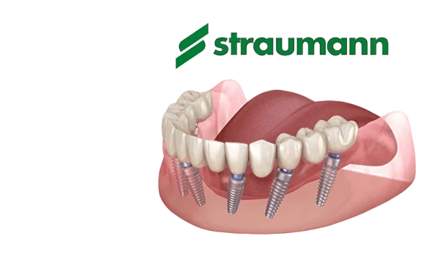 Straumann All-on-6: почему это выбор для идеальной улыбки с гарантией на 10 лет
