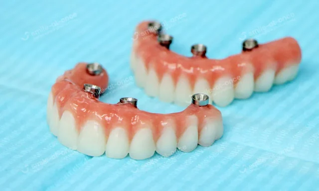 Металлопластмассовые протезы: плюсы и минусы