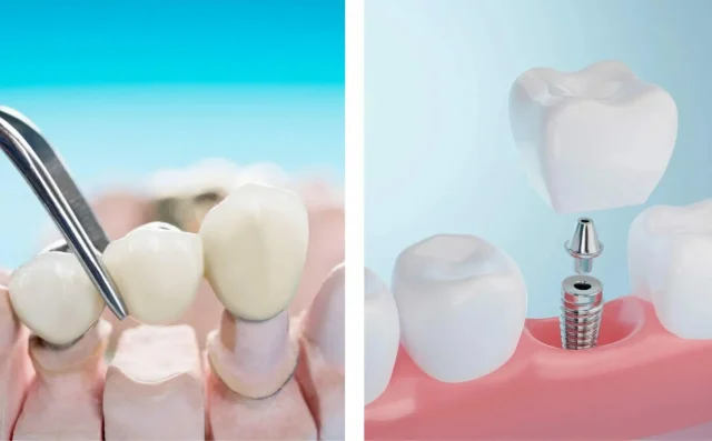 Имплантация или мостовидный протез: как выбрать без сомнений