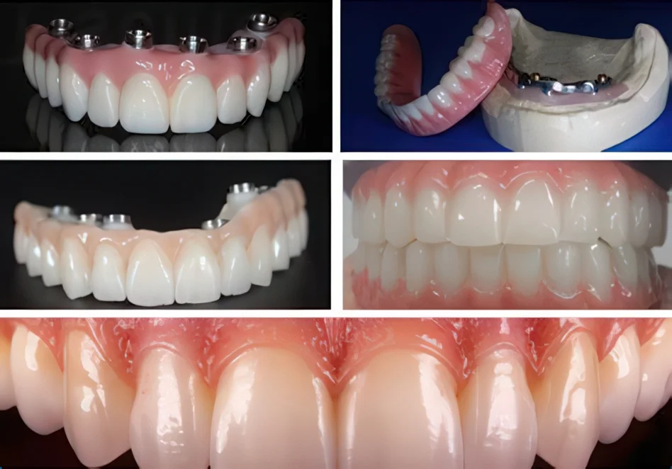 Подобрать материал для протеза