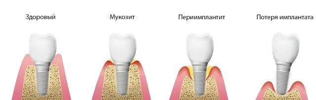 Стадии развития осложнений после имплантации – от периимплантита до отторжения
