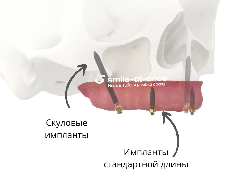 Сравнение имплантов - скуловых и стандартной длины