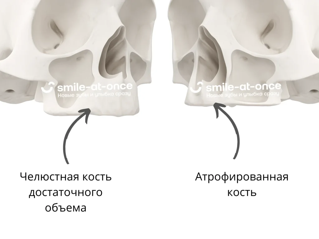 Показания к разным протоколам имплантации - степень атрофии кости верхней челюсти