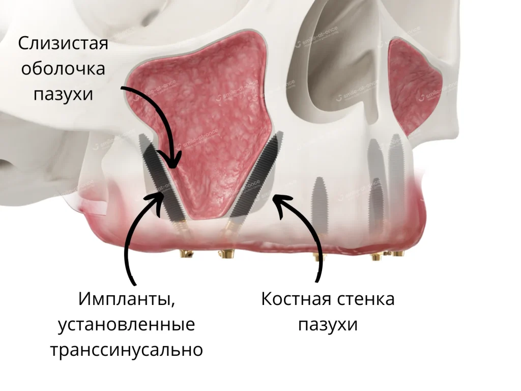 Транссинусальная установка имплантов при V-II-V