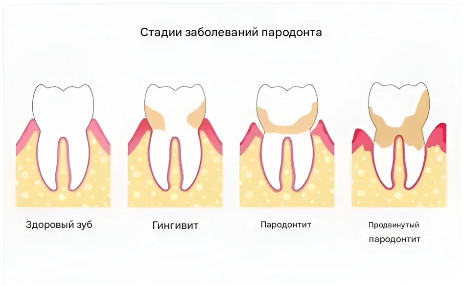 Стадии пародонтоза