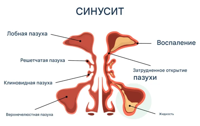 Имплантация при хроническом гайморите