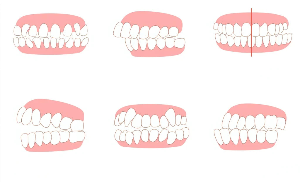 Виды неправильного прикуса