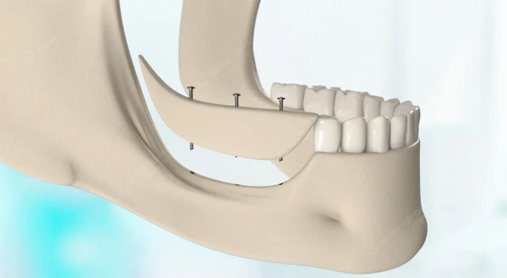 подсадка костного блока