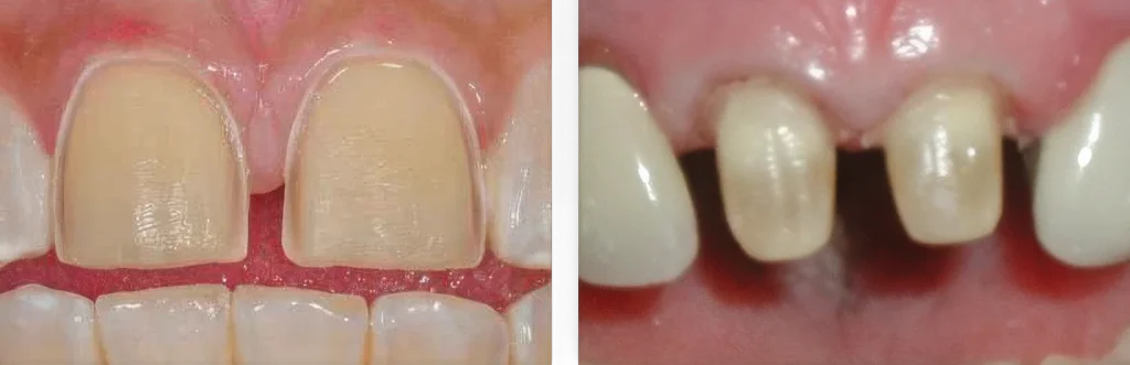 Подготовка зубов под установку виниров и коронок