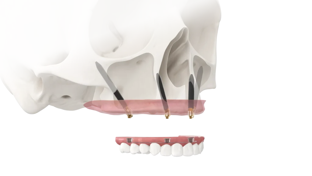 Скуловые импланты и армированный протез