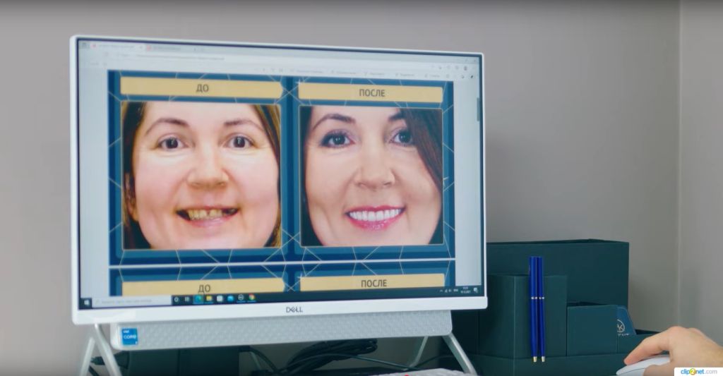 Отреставрировать зуб. Результат всего за 1-2 часа.