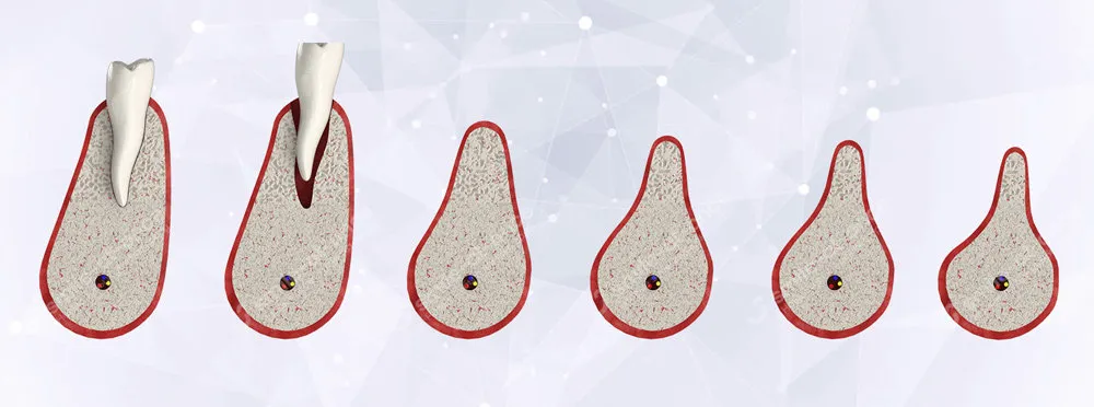 Как атрофируется кости после утраты зуба