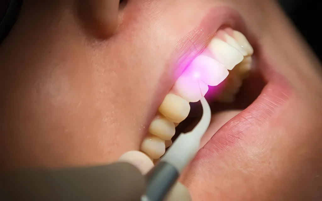 Лазер в стоматологии