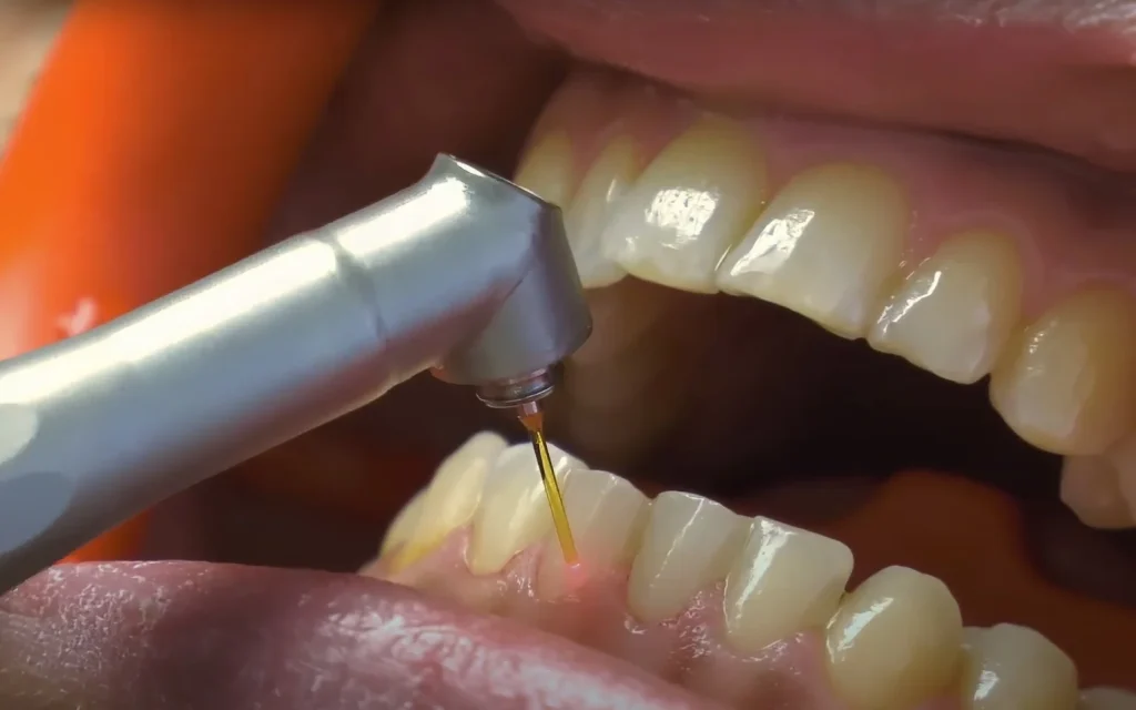 Лазер в стоматологии