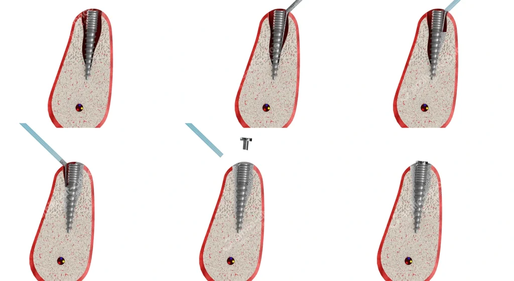 Имплантация при дефиците костной ткани