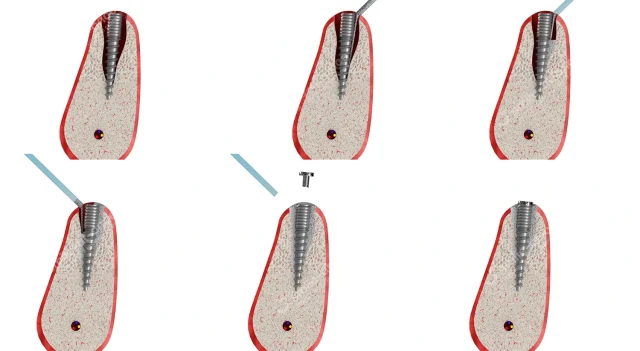 Имплантация при дефиците костной ткани