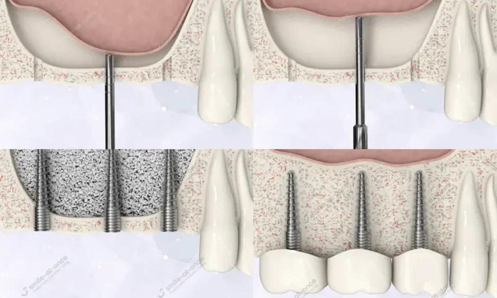Этапы закрытого синус-лифтинга